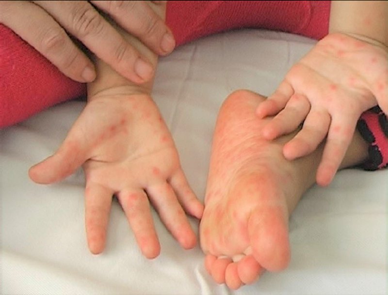 Trẻ nhỏ dưới 5 tuổi là đối tượng có nguy cơ mắc bệnh tay chân miệng cao nhất